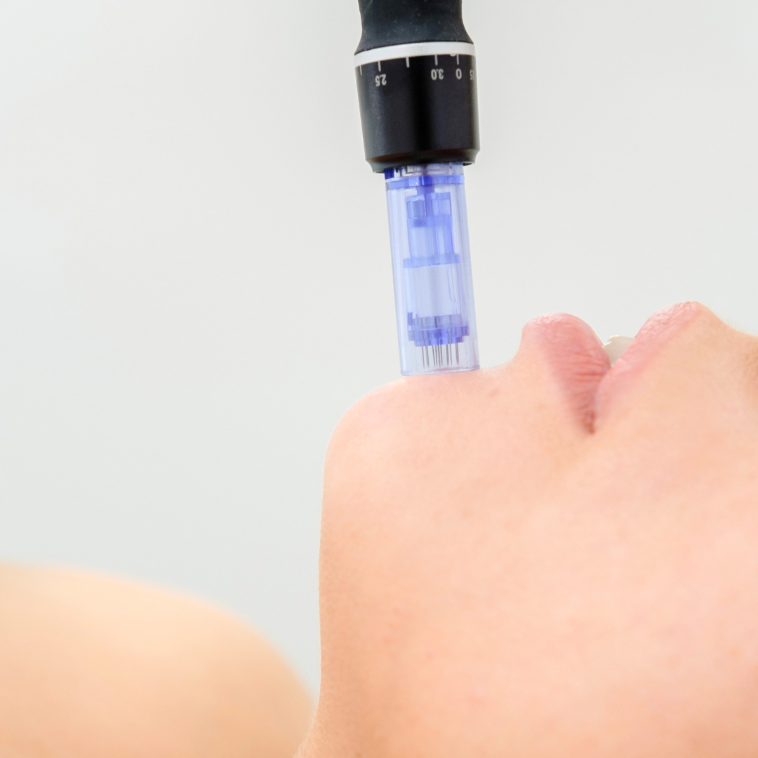 Microneedling3 Microneedling3