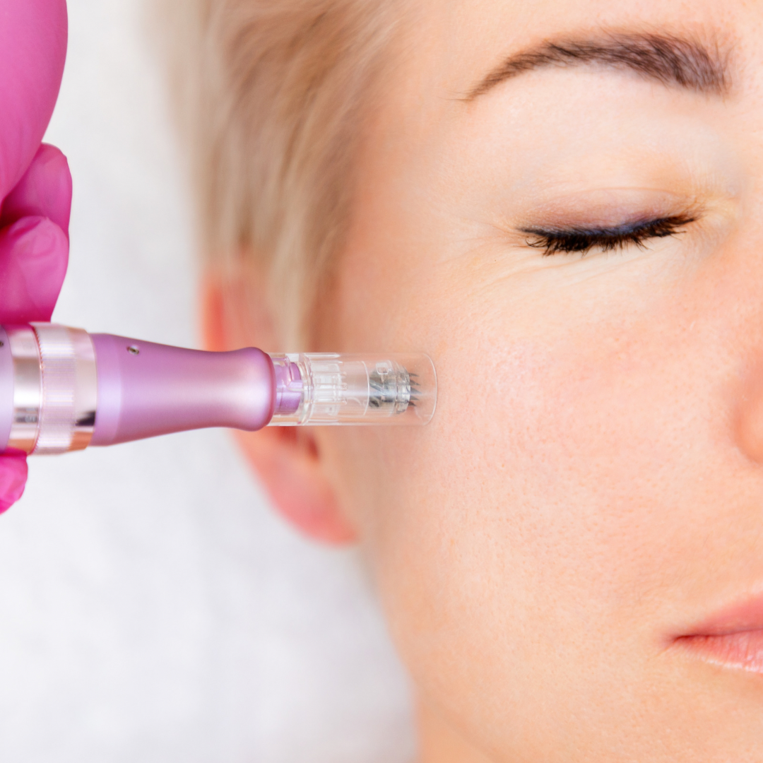 Microneedling2 Microneedling2