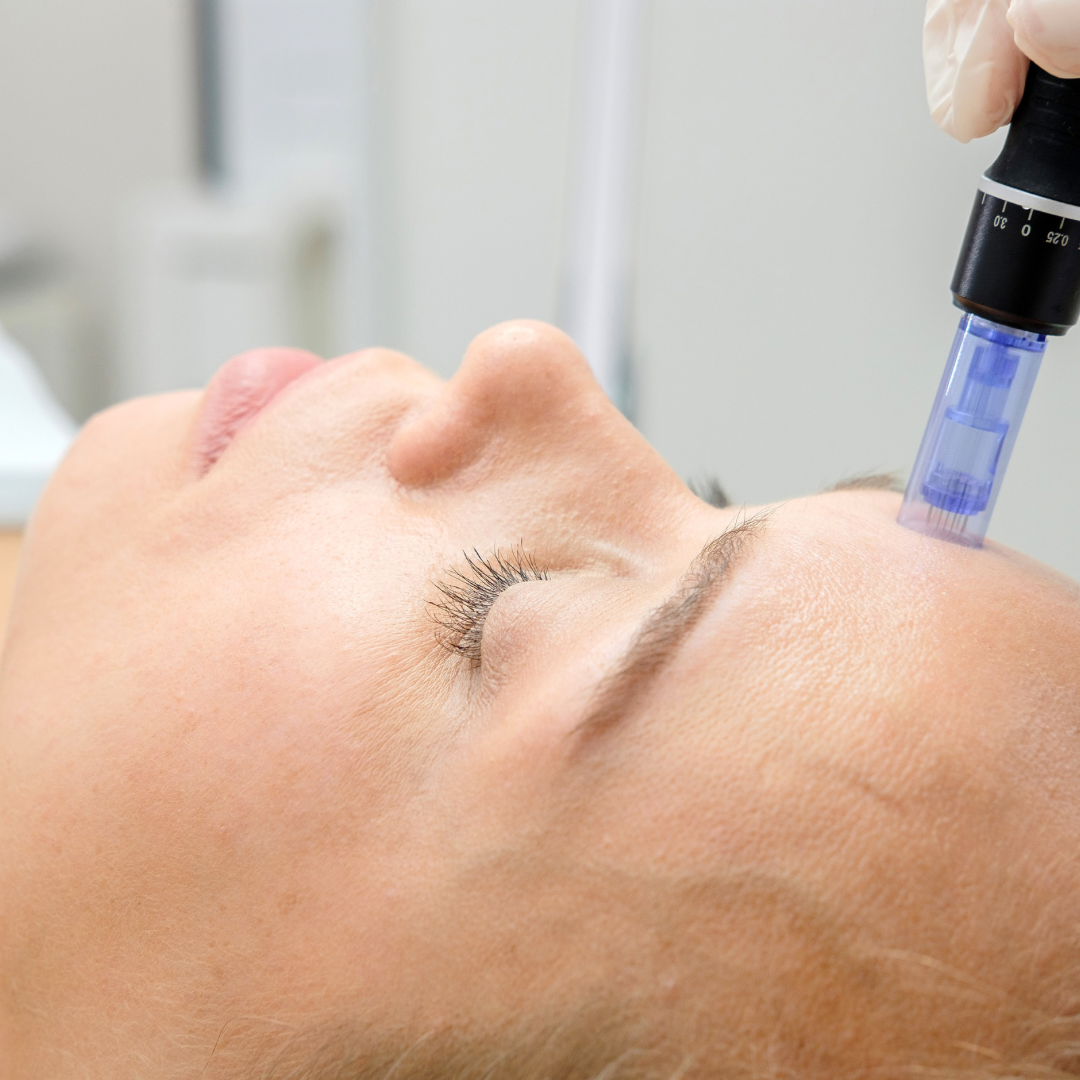 Microneedling5 Microneedling5